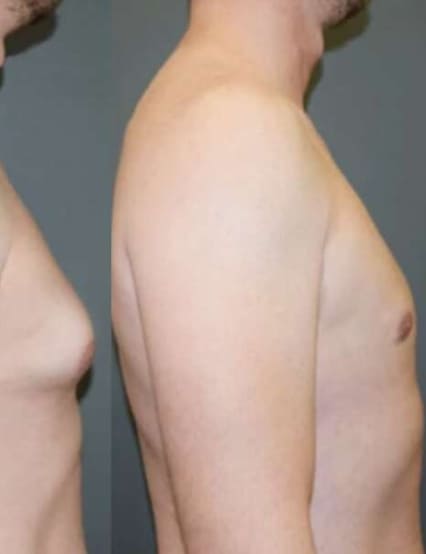 http://www.phoenixcosmeticcentre.com/gynaecomastia
